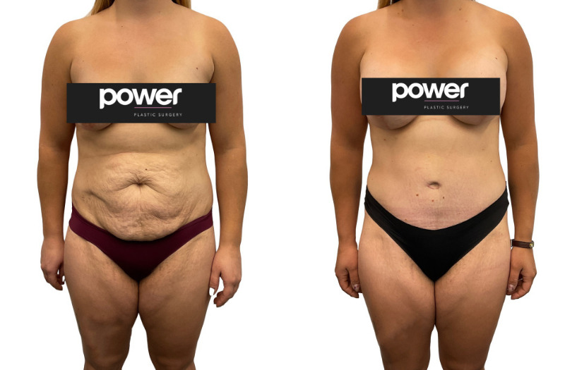 Tummy Tuck before and after, real patient of Dr. Stephanie Power in Toronto