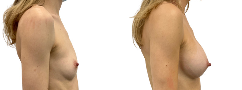 Breast augmentation merged 1.jpg — Power Plastic Surgery