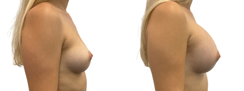 Breast augmentation merged 5.jpg — Power Plastic Surgery