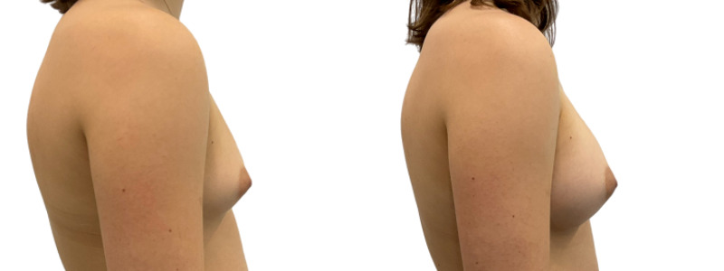 Breast augmentation merged 1.jpg — Power Plastic Surgery