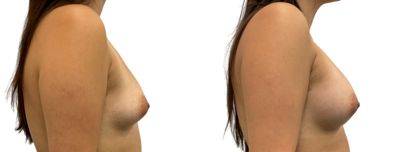 Breast augmentation merged 3.jpg — Power Plastic Surgery