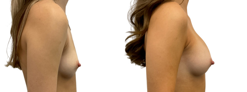 Breast augmentation merged 5.jpg — Power Plastic Surgery