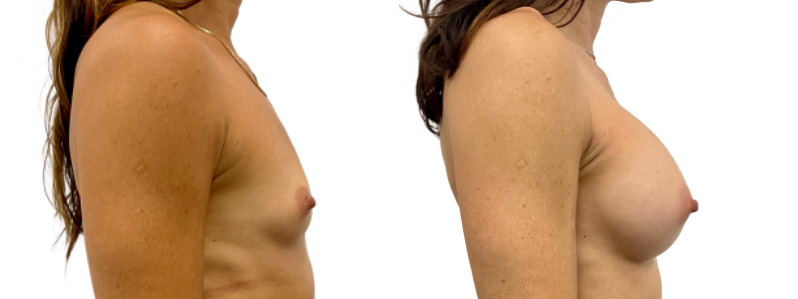 Breast augmentation merged 1.jpg — Power Plastic Surgery