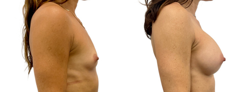 Breast augmentation merged 2.jpg — Power Plastic Surgery