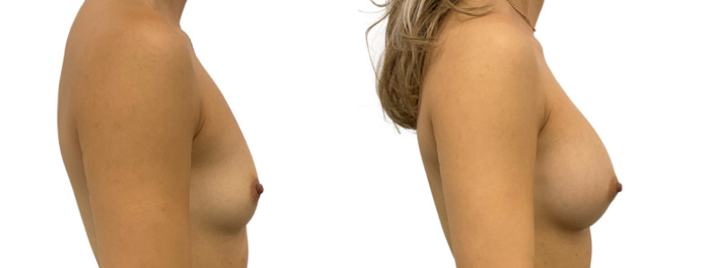 Breast augmentation merged 4.jpg — Power Plastic Surgery