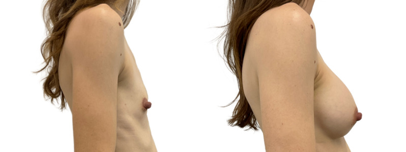 Breast augmentation merged 6.jpg — Power Plastic Surgery
