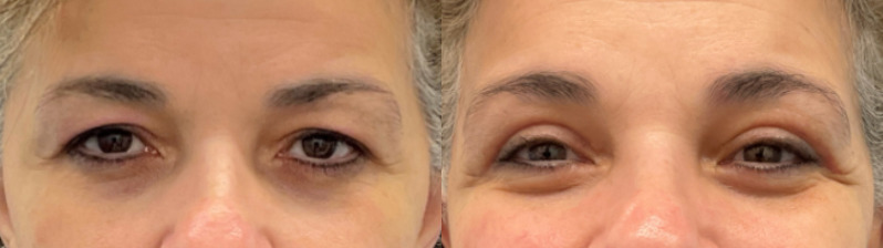 Eyelid surgery before and after, patient of Dr. Stephanie Power in Toronto
