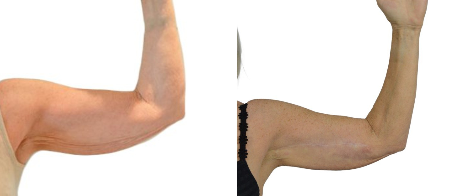 Arm lift before and after, Power Plastic Surgery Toronto