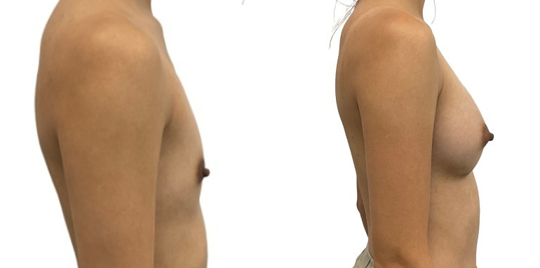 Breast augmentation merged 1.jpg — Power Plastic Surgery