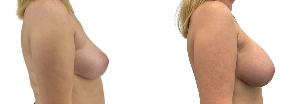 Breast augmentation merged.jpg — Power Plastic Surgery
