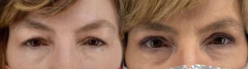 Eyelid surgery before and after, patient of Dr. Stephanie Power in Toronto